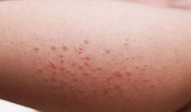 vücutta parazit varlığının dış belirtileri